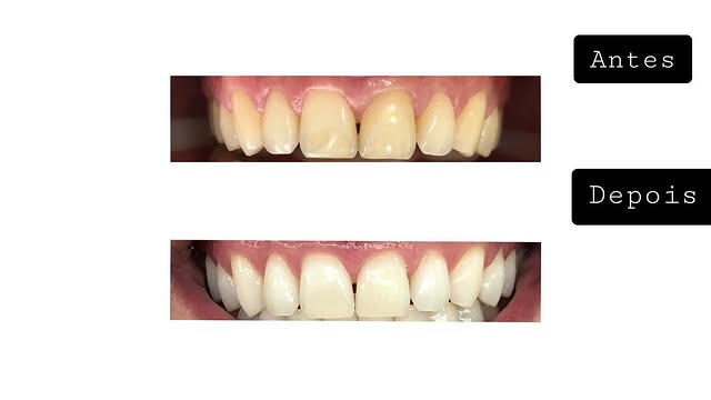 Clareamento dental — antes e depois